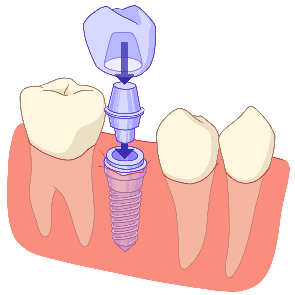 34 Implant