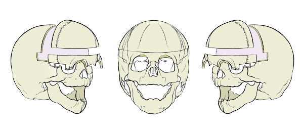 Avancement fronto orbitaire