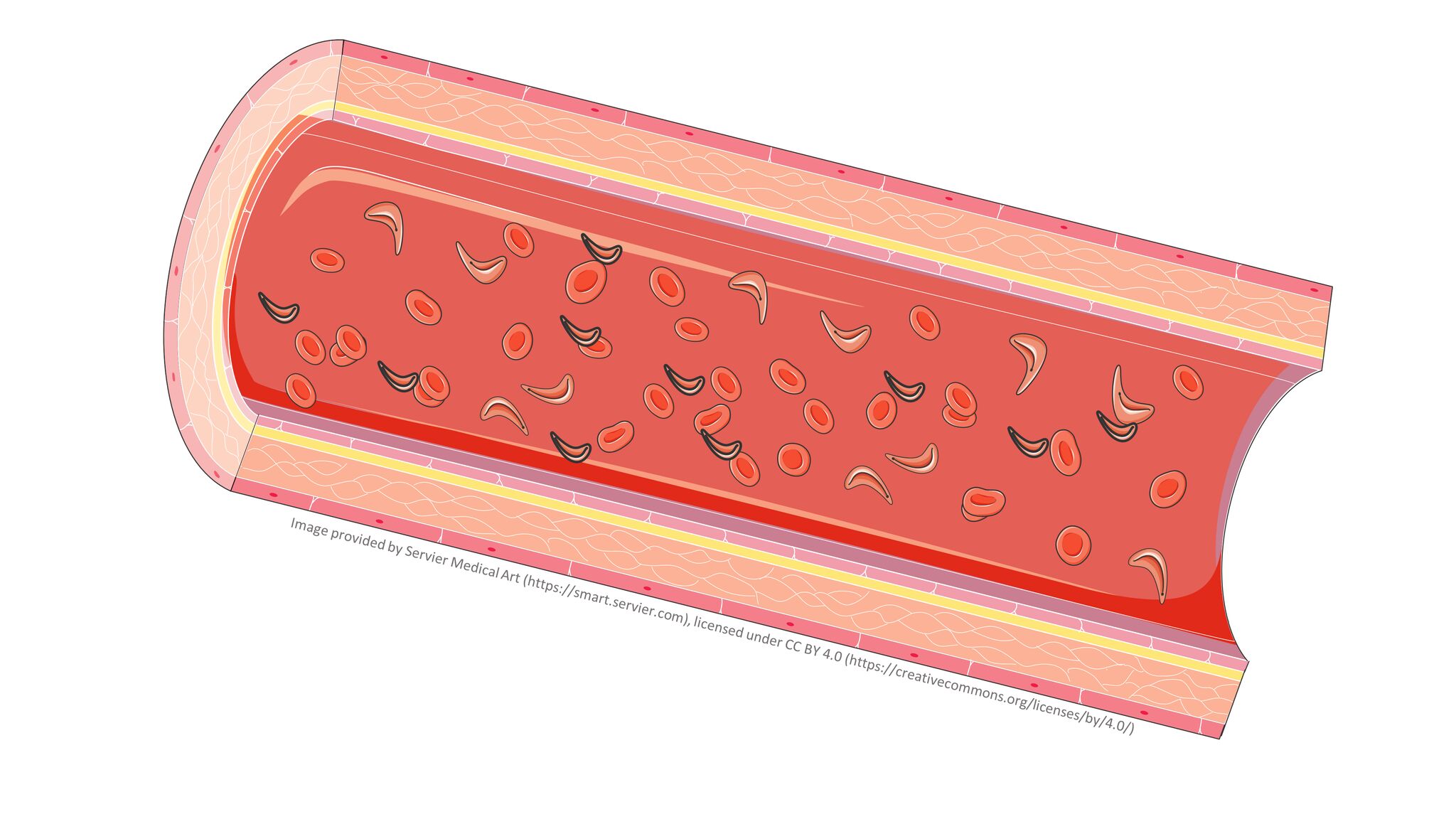 Drepanocytose cellules faucilles