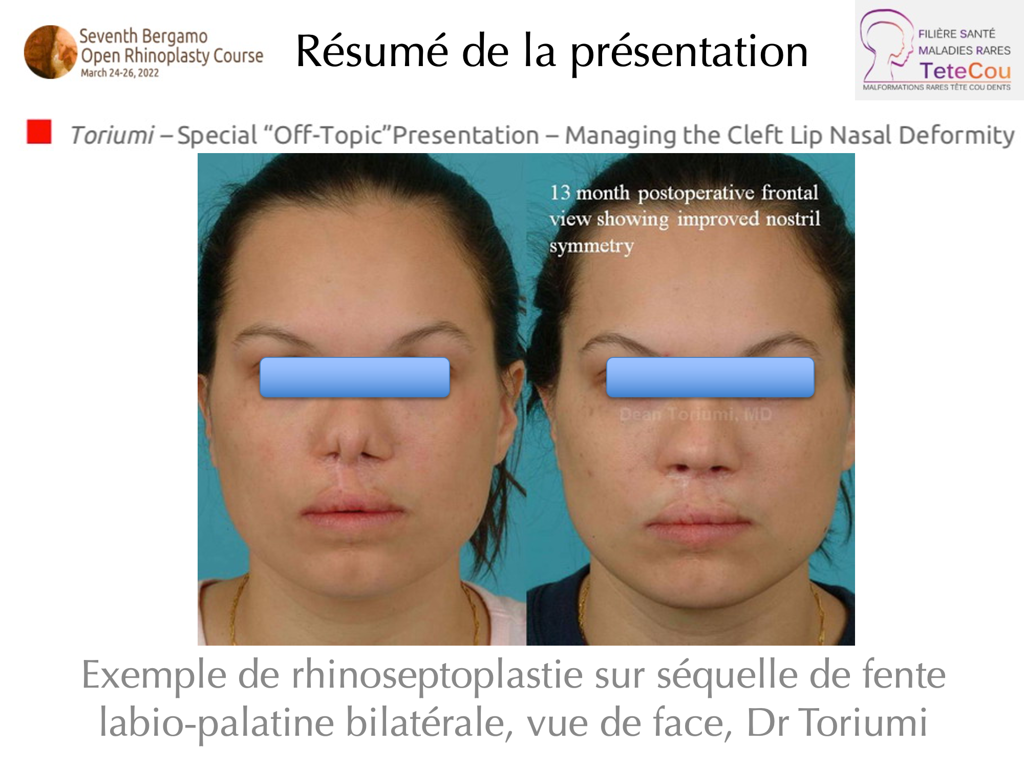 Image Retour JB Caruhel Bergamo rhinoplasty course 10