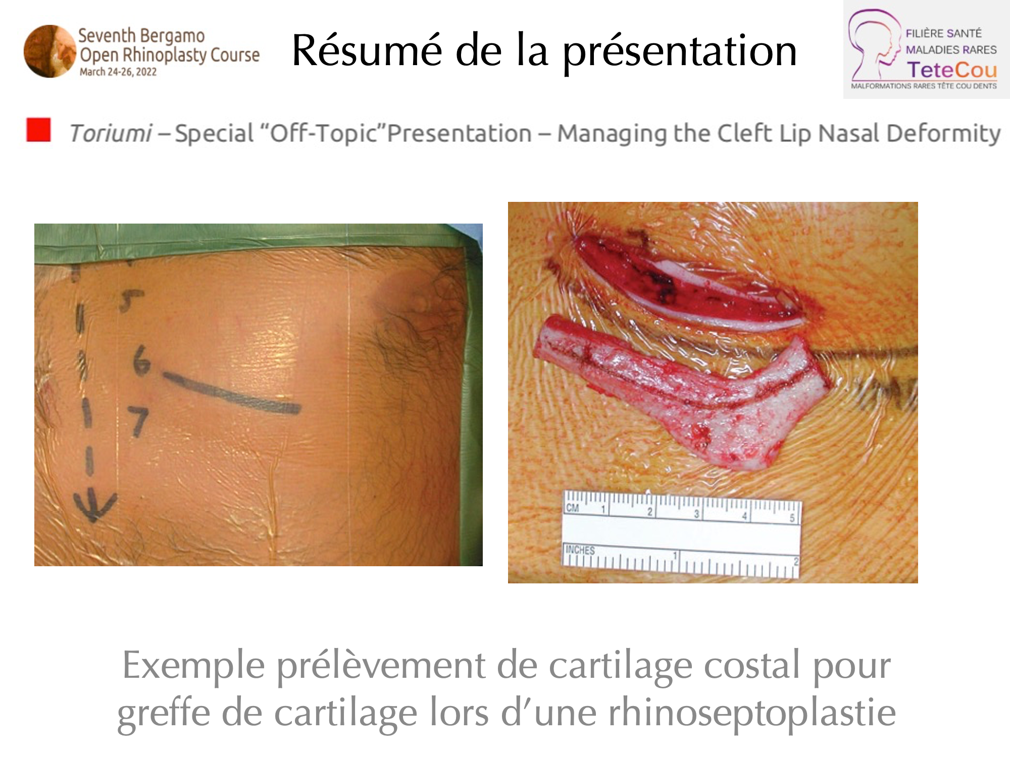 Image Retour JB Caruhel Bergamo rhinoplasty course 7