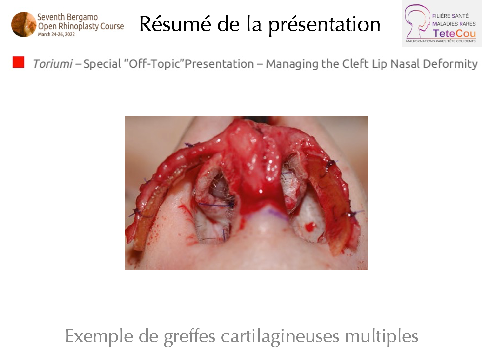 Image Retour JB Caruhel Bergamo rhinoplasty course 8