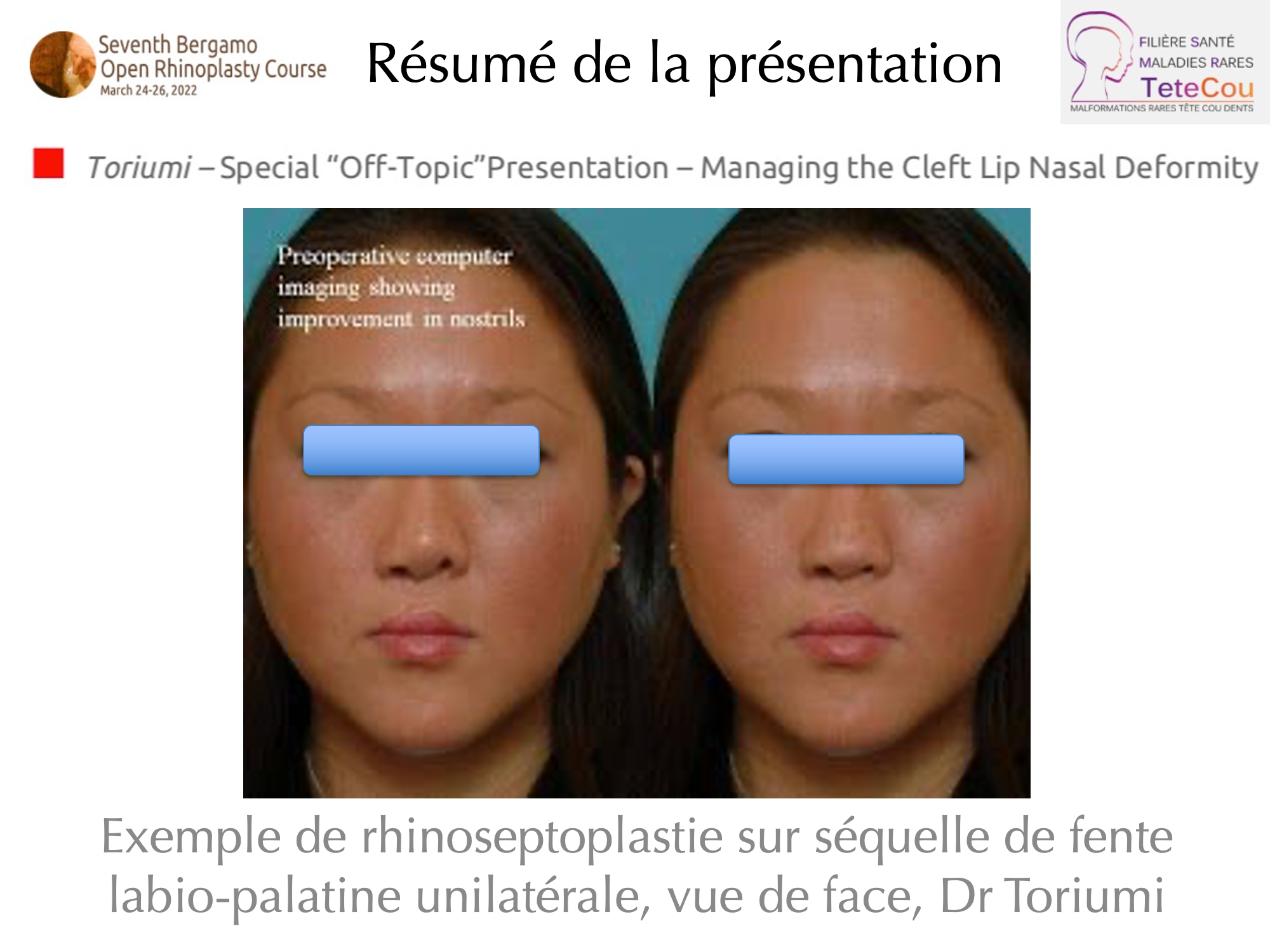 Image Retour JB Caruhel Bergamo rhinoplasty course 9