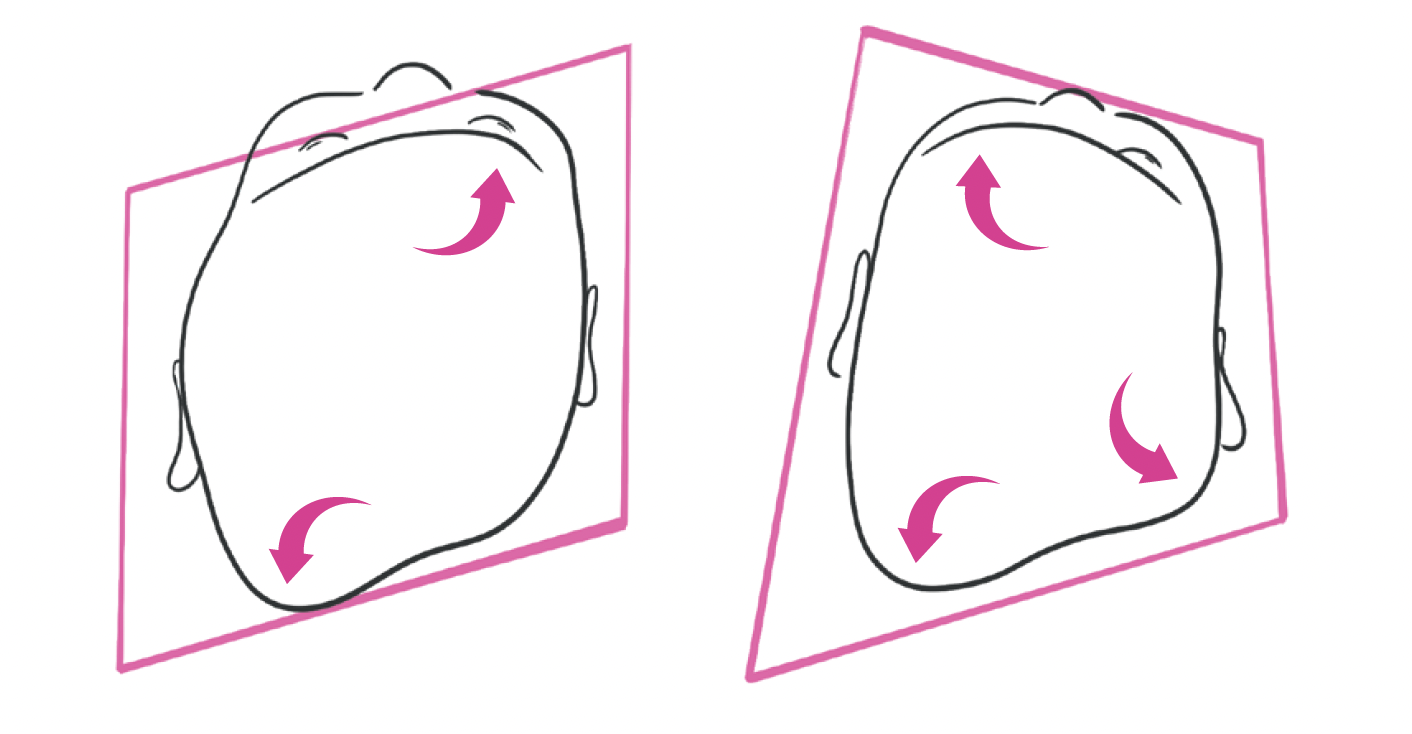 Livret CRANIOST Plagiocéphalie lambdoide#positionnelle