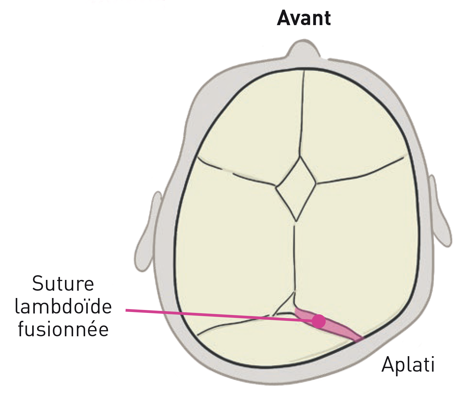 Livret CRANIOST Plagiocéphalie postérieure blanc